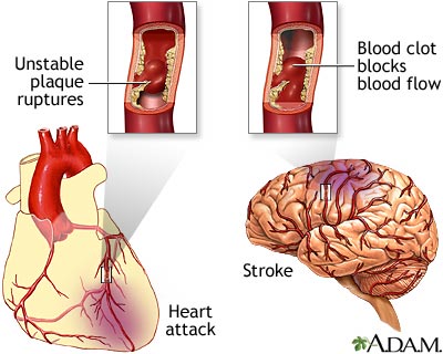 Heart Attack. for heart disease include